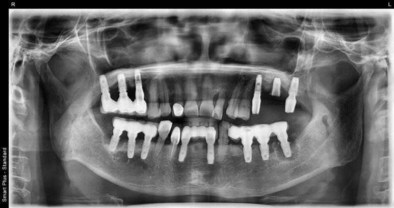임플란트재수술, 케이스로 보여드립니다. 관련 이미지 2