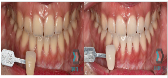 자가치아미백 VS 전문가 치아미백, 차이를 알고 하셔야합니다. 관련 이미지 2