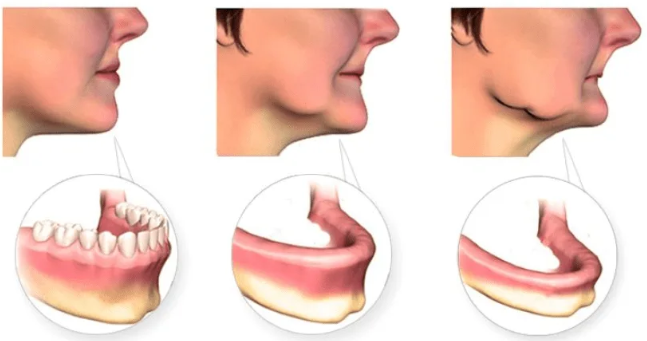 강남구임플란트, 뼈이식 과정부터 치료기간까지 알려드립니다 관련 이미지 3