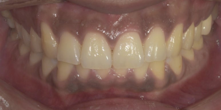 잇몸착색, 변색되어 검은 잇몸 선홍빛으로 되돌리는 방법 관련 이미지 6