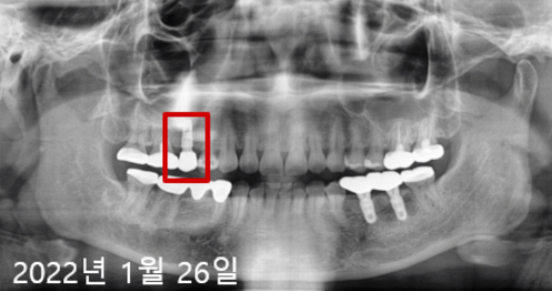 네비게이션인플란트가격? 이 글로 종결합니다. 관련 이미지 5