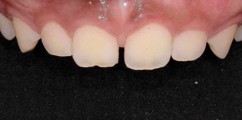 치아성형비용, 비싼 것만은 아닙니다. 관련 이미지 6