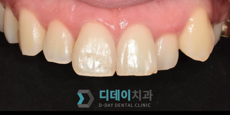 라미네이트후기, 치료사례만 모아 보여드립니다 관련 이미지 15