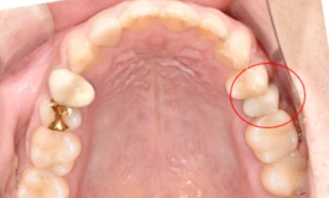 임플란트교체? 걱정되시는분들만 보세요. 관련 이미지 5