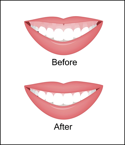 잇몸절제술? 답답한 인상이 고민입니다... 관련 이미지 1