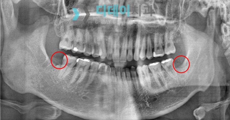 강남사랑니발치? 치과의사가 말씀드립니다. 관련 이미지 3