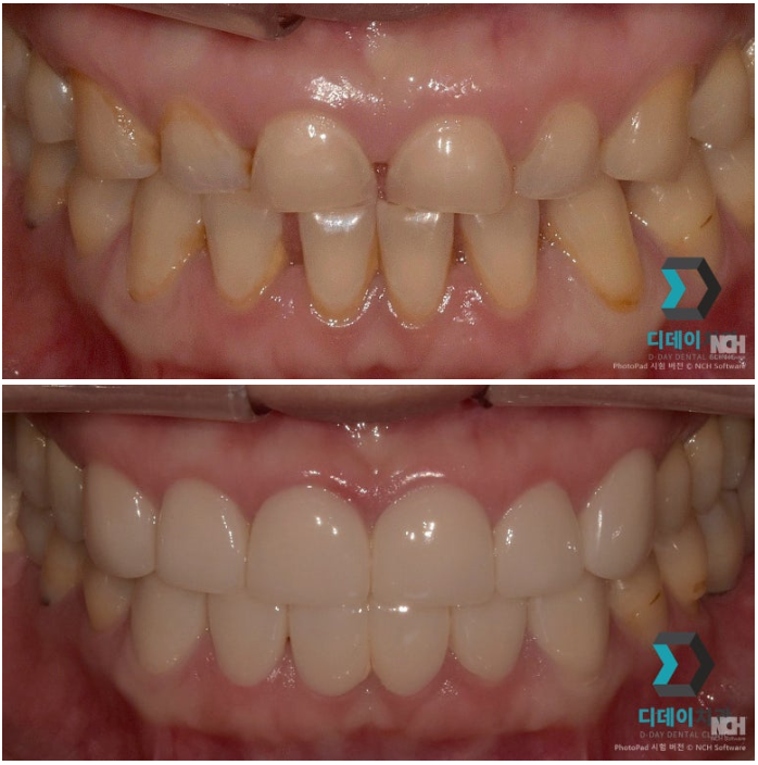 대치역치과, 라미네이트 잘하는 곳 찾으세요? 2가지면 됩니다 관련 이미지 2