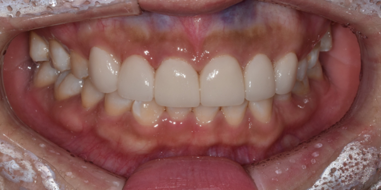 라미네이트 전후 비교, 주의사항, 비용까지 총정리 관련 이미지 10