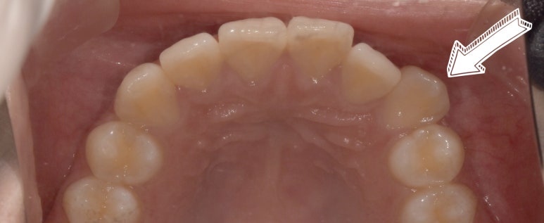 덧니교정만 된다? 라미네이트로도 덧니 치료 가능합니다. 관련 이미지 6