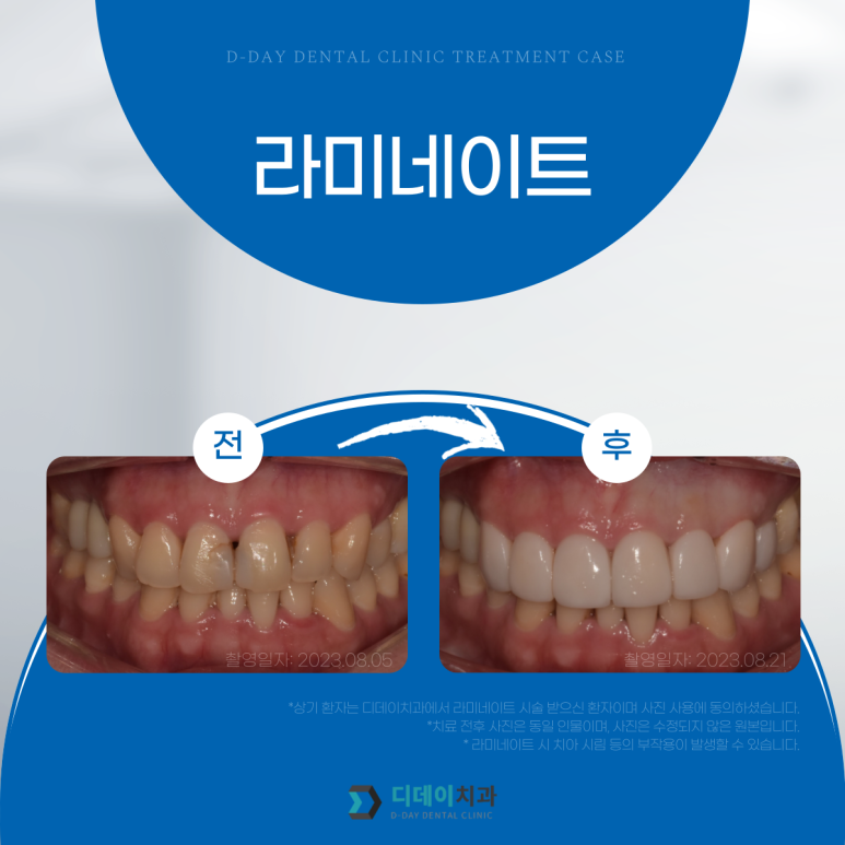 라미네이트비용 궁금하다면? 치과의사의 팩트체크! 관련 이미지 4