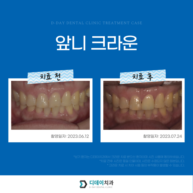 앞니성형, 종류별 가격과 전후사진까지 완벽 정리 관련 이미지 18
