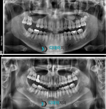 삼성역사거리 치과 임플란트 뼈이식 없이 가능 여부 의사 설명 관련 이미지 3