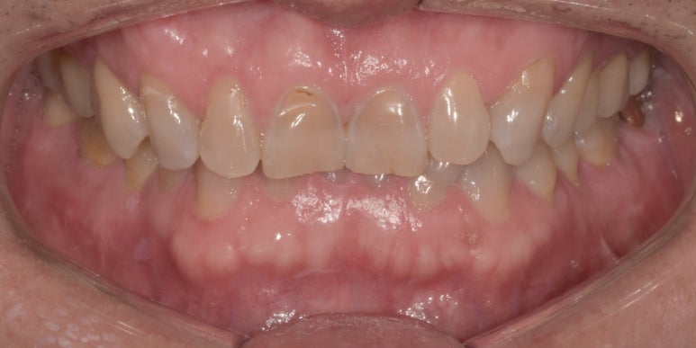 라미네이트후기, 닳아있고 변색된 치아 치료한 최신사례 관련 이미지 2