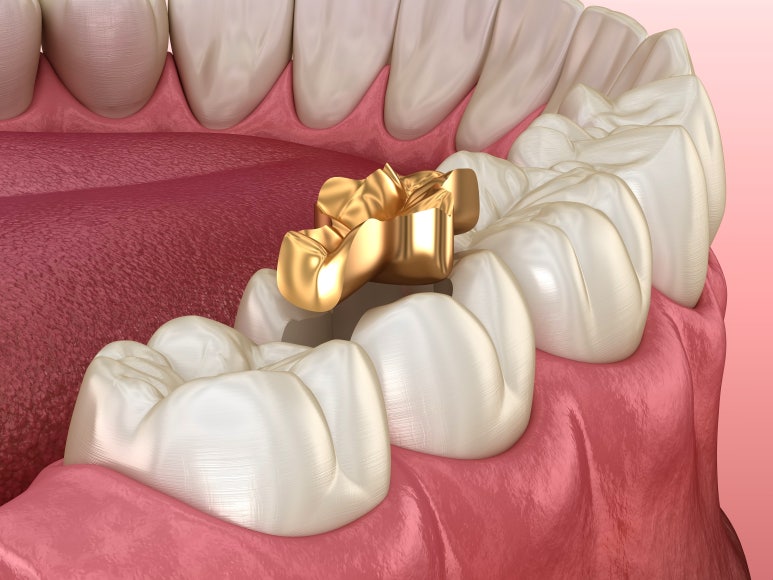 충치치료 기간, 과정, 비용까지 전문의가 알려드립니다. 관련 이미지 12