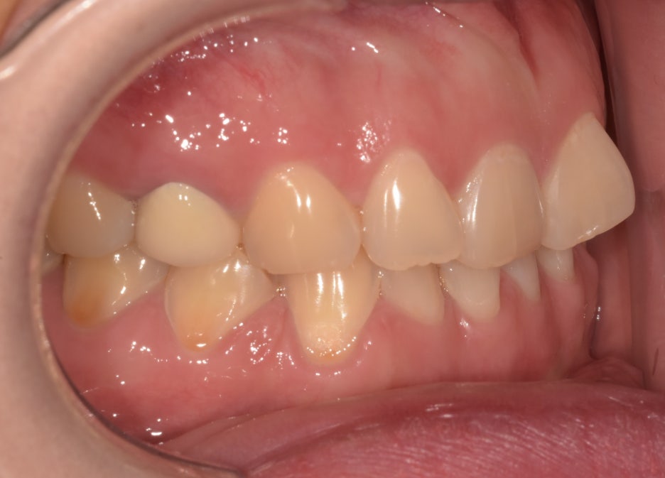 [진심인터뷰] 라미네이트 오해와 진실, #내돈내산 환자가 밝혀드립니다 ② 관련 이미지 3