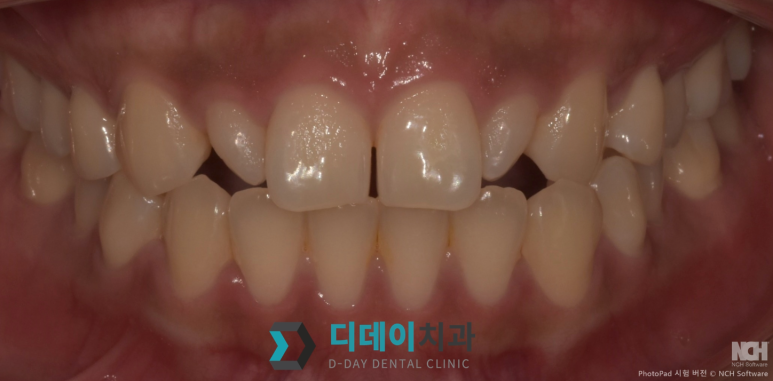 치아미백 라미네이트 잘하는 곳 찾는 2가지 기준 관련 이미지 8