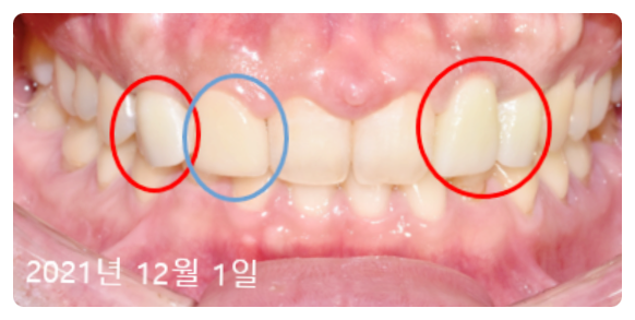 앞이빨임플란트? 3가지 원칙부터 확인하세요. 관련 이미지 3
