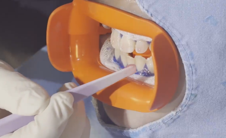 치아미백시술비용, 저렴하면 위험한 2가지 이유 관련 이미지 3