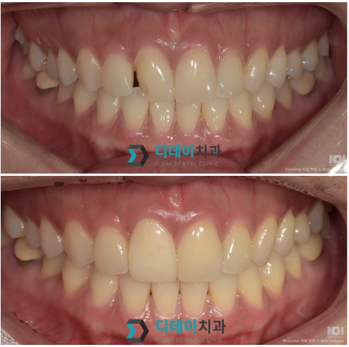 선정릉치과 라미네이트 vs 크라운, 어떤 치료가 맞을까요? 관련 이미지 6