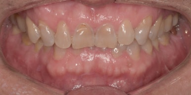 라미네이트후기, 닳아있고 변색된 치아 치료한 최신사례 관련 이미지 3