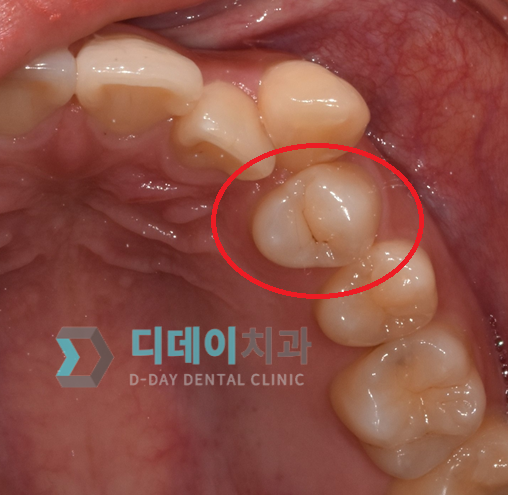 충치치료기간, 치료별 내원횟수와 기간까지 총정리 관련 이미지 2