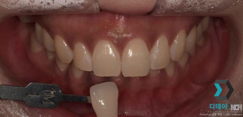 치아미백후기 믿으면 안 되는 이유? 전문의가 설명드립니다. 관련 이미지 7