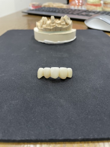 앞니브릿지, 오래된 브릿지교체하신 치료사례와 비용공개합니다. 관련 이미지 3