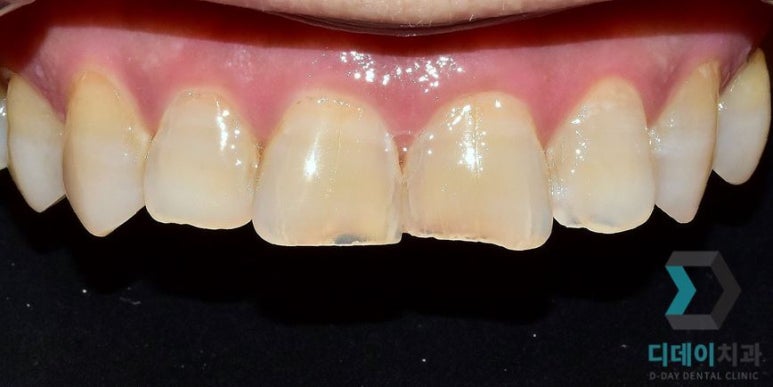 치아성형 종류, 비용, 장단점까지 완벽정리 관련 이미지 7