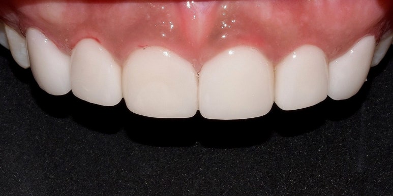 치아성형비용, 비싼 것만은 아닙니다. 관련 이미지 7