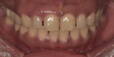 작은치아라미네이트, 치아삭제 없이 가능하다? 관련 이미지 5