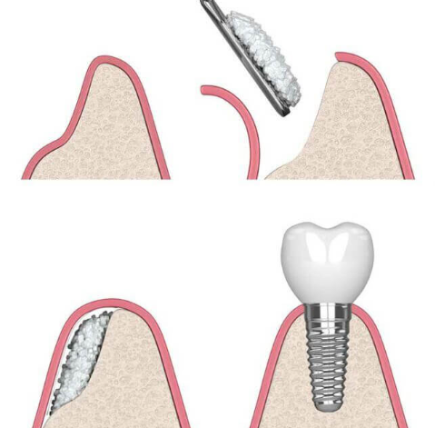강남구임플란트, 뼈이식 과정부터 치료기간까지 알려드립니다 관련 이미지 4