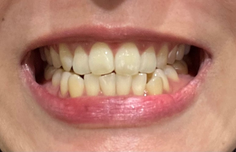 치과치아미백 #내돈내산 찐후기 (feat. 직원이 직접 받은 솔직후기) 관련 이미지 8