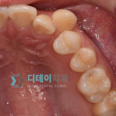 치아레진? 앞니, 치경부, 어금니 각 부위별 치료사례&비용 관련 이미지 10