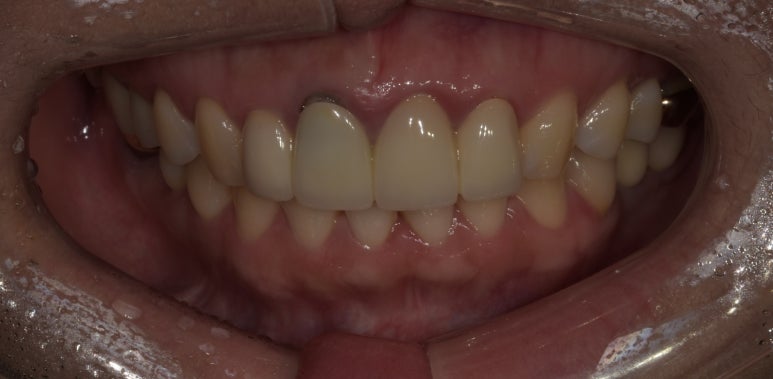 앞니브릿지교체? 브릿지를 크라운으로 교체 가능할까? 관련 이미지 4