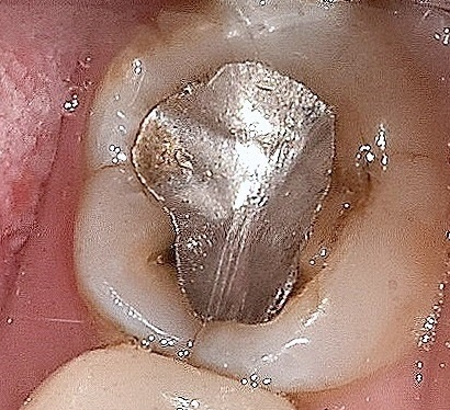 아말감 레진 인레이 어떤 차이? 속시원하게 알려드릴게요. 관련 이미지 4