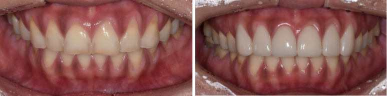 최소삭제라미네이트, 비용부터 치과 고르는 방법 관련 이미지 6
