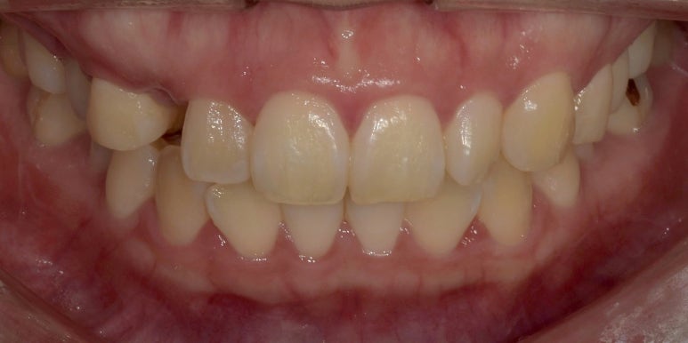 앞니브릿지와 라미네이트를 같이 해도 자연스러울까? 사례로 보여드립니다. 관련 이미지 3