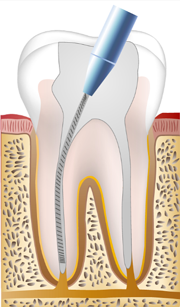 신경치료고통? 통증을 줄이는 방법은 바로 OO입니다. 관련 이미지 8
