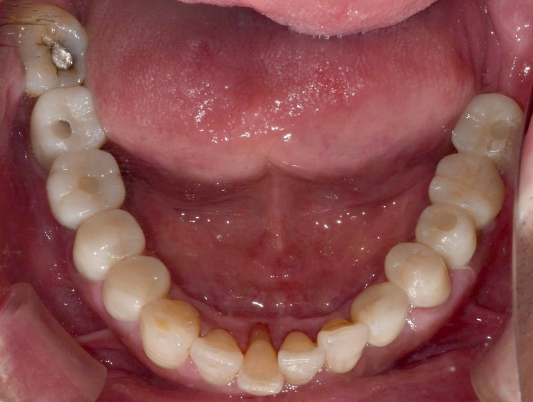 임플란트건강보험, 추가비용 없이 가능할까요? 관련 이미지 10