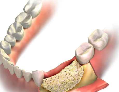 50대 이후 임플란트, 더 기다리면 안되는 이유 정확히 알려드립니다. 관련 이미지 4