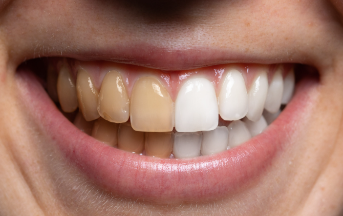 선릉역치아미백, 후기보다 먼저봐야 할 것이 있습니다 관련 이미지 2