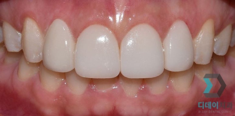 라미네이트후기, 치료사례만 모아 보여드립니다 관련 이미지 18