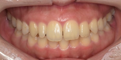 라미네이트 전후사진과 치료비용까지 숨김없이 알려드립니다. 관련 이미지 2