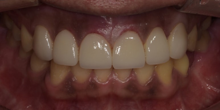치간이개라미네이트, 벌어진 앞니 개선한 최신사례 관련 이미지 11