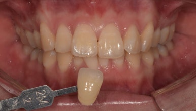 [진심인터뷰] &ldquo;한국까지 와서 원데이치아미백 했어요&rdquo; - 일본에서 온 두 친구 이야기 관련 이미지 2