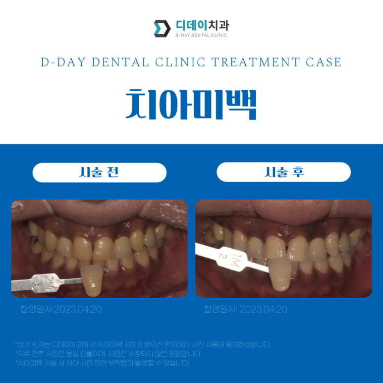 치과치아미백, 700명 이상이 디데이치과를 선택한 이유? 관련 이미지 3