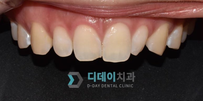 작은이빨, 왜소치? 치아 크기를 키우고 싶은 분만 <필독> 관련 이미지 7