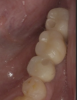 임플란트흔들림? 당황하지 말고 바로 해야할 일은? 관련 이미지 4