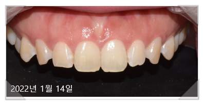 잇몸수술비용? 이 글로 종결합니다. 관련 이미지 4