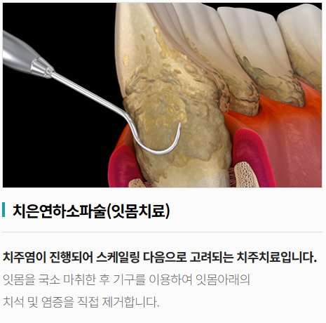 잇몸치료후통증, 며칠째라면 이것만큼은 알아야 합니다 관련 이미지 3